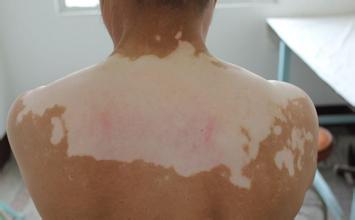 芜湖散发型白癜风治疗